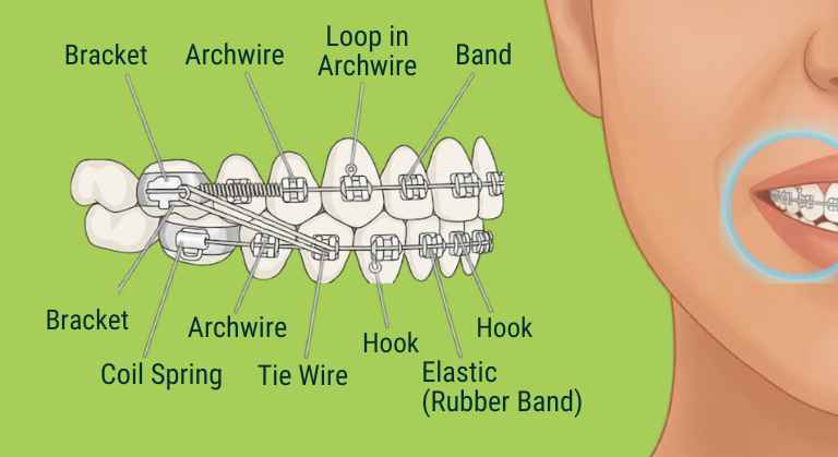 Braces illustration