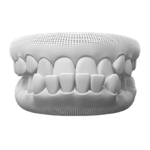 Underbite